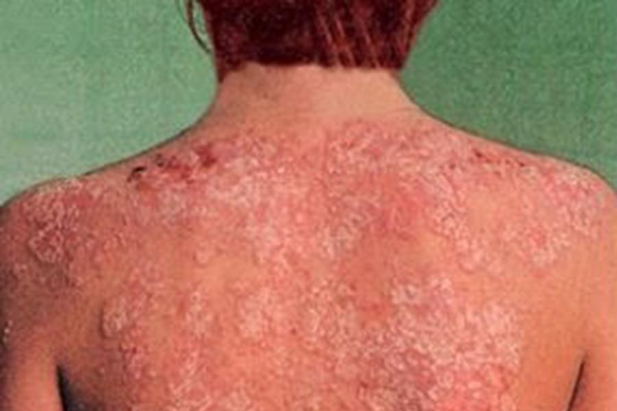 Dermatología hoy en la consulta de primaria